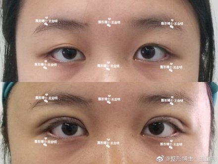王金明雙眼皮案例