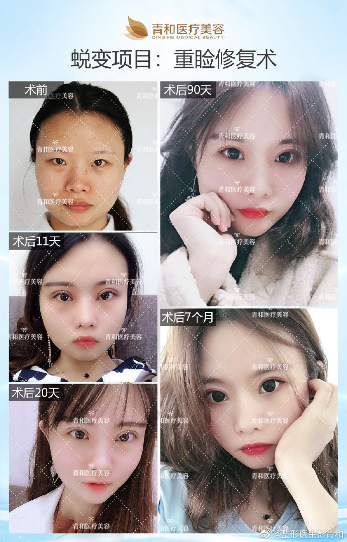 彭青和雙眼皮案例