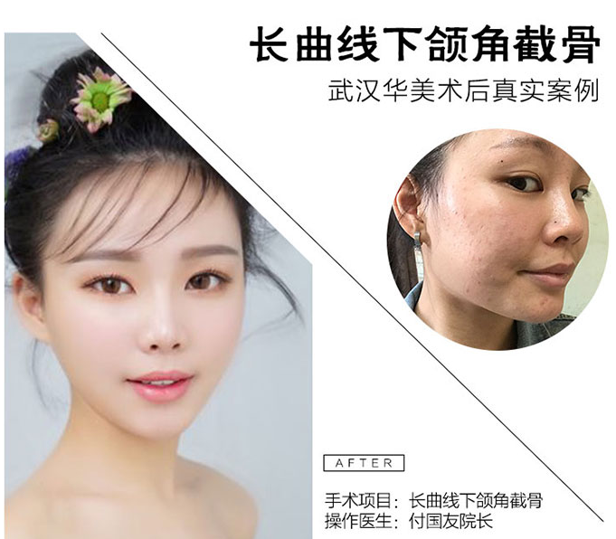 付國友下頜角案例