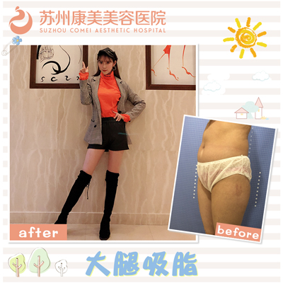 劉道功大腿吸脂案例