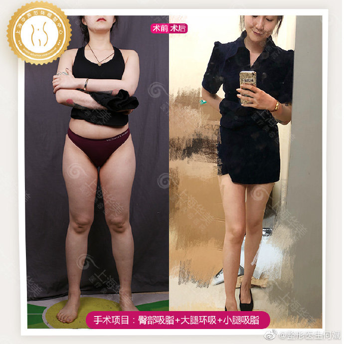 何斌醫(yī)生大腿環(huán)吸案例