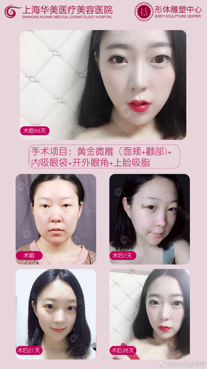 何斌醫(yī)生面部精雕案例