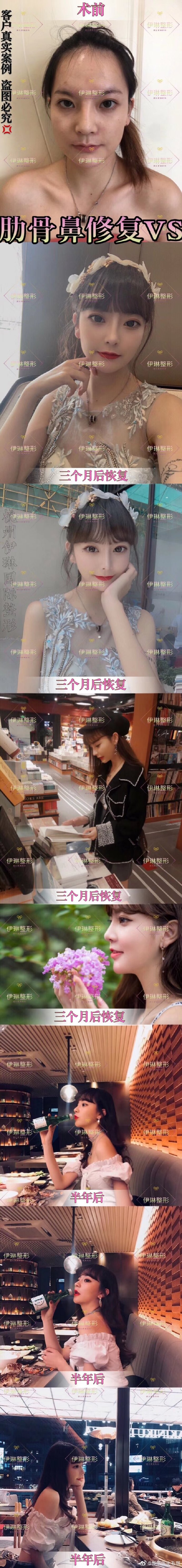 毛琪鼻修復案例