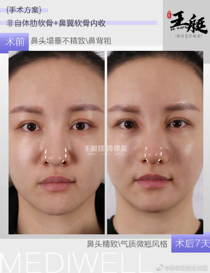 王艇鼻修復案例