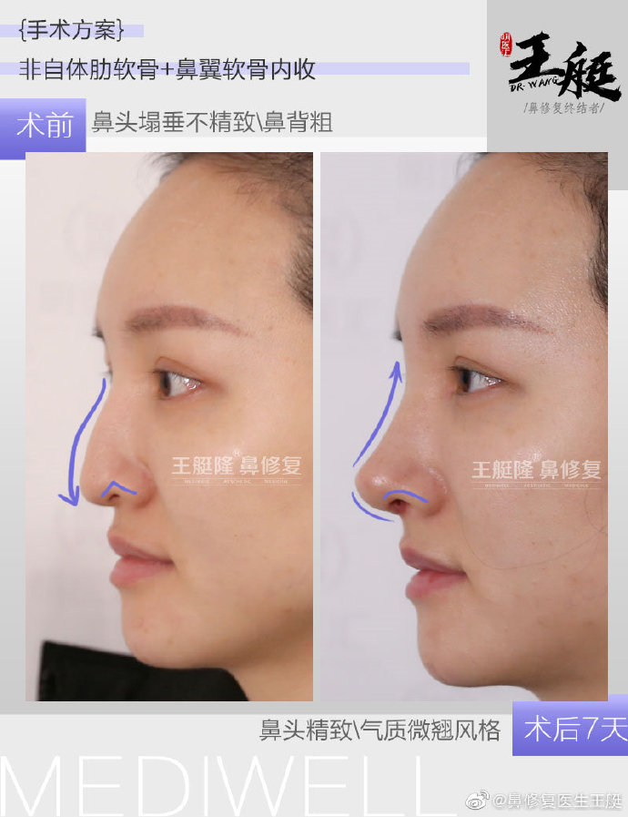 王艇鼻修復案例