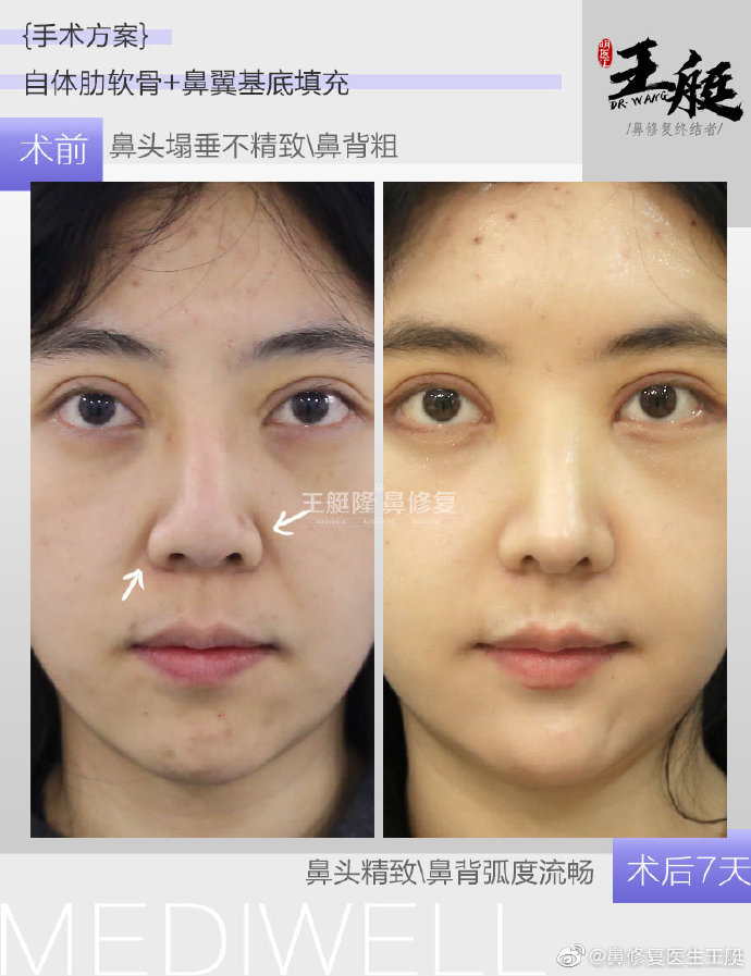王艇鼻修復案例