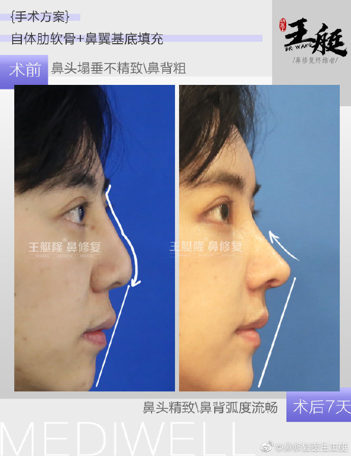 王艇鼻修復案例