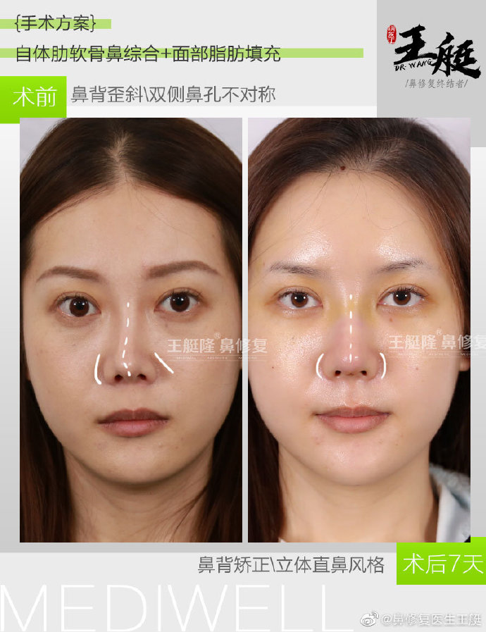 王艇鼻修復案例