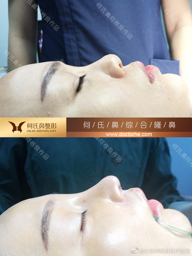 何棟良鼻修復案例