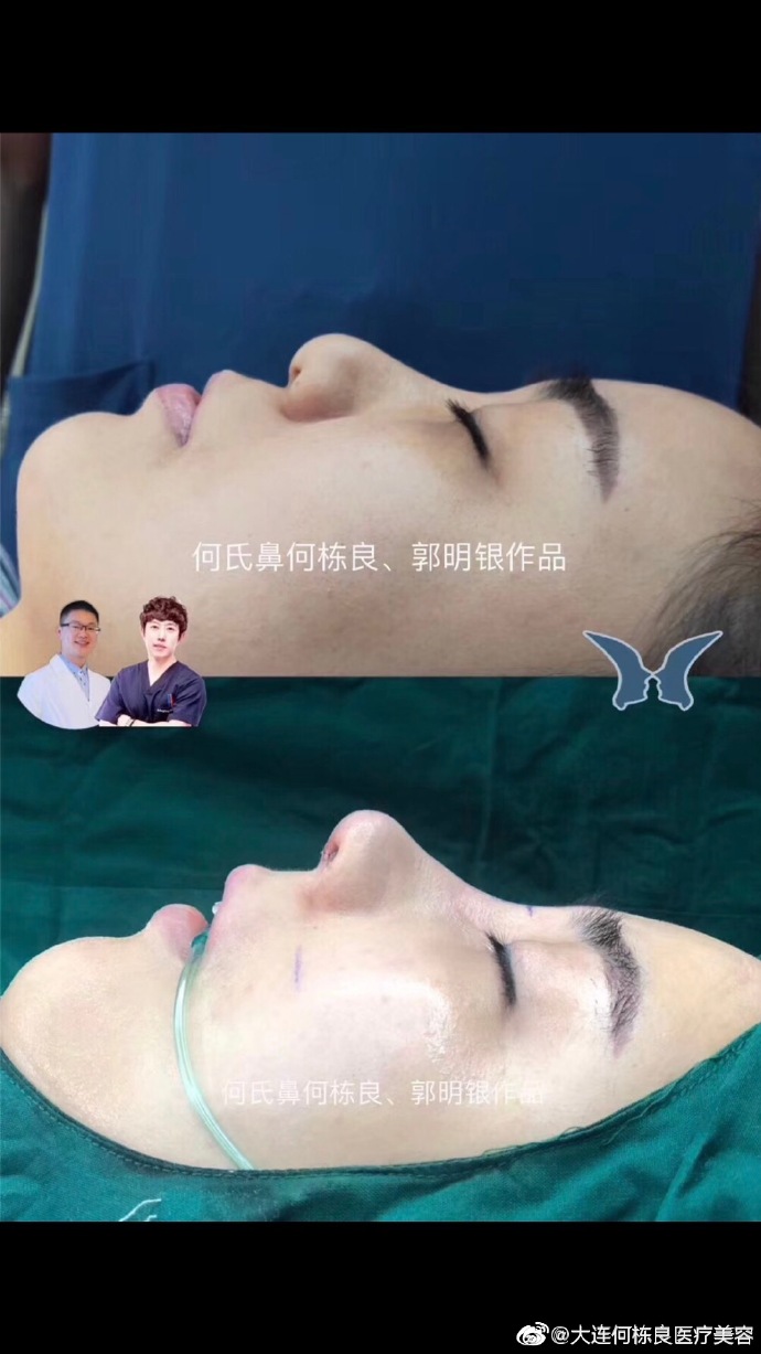 何棟良鼻修復案例