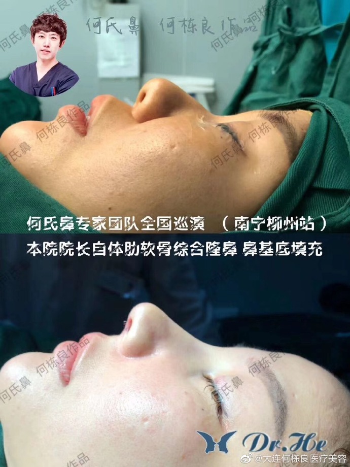 何棟良鼻修復案例
