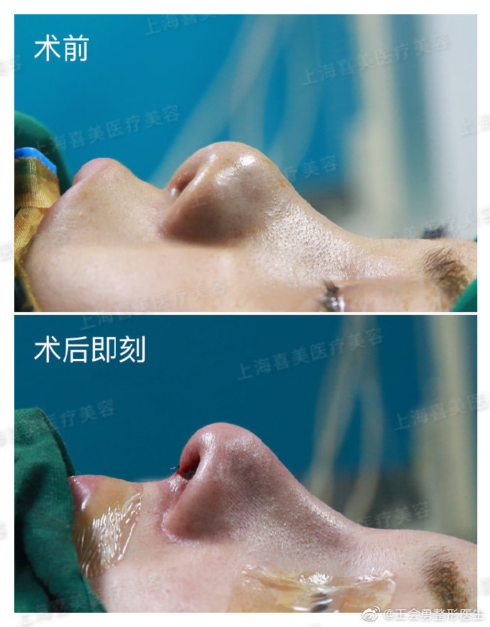 王會勇全肋鼻修復案例