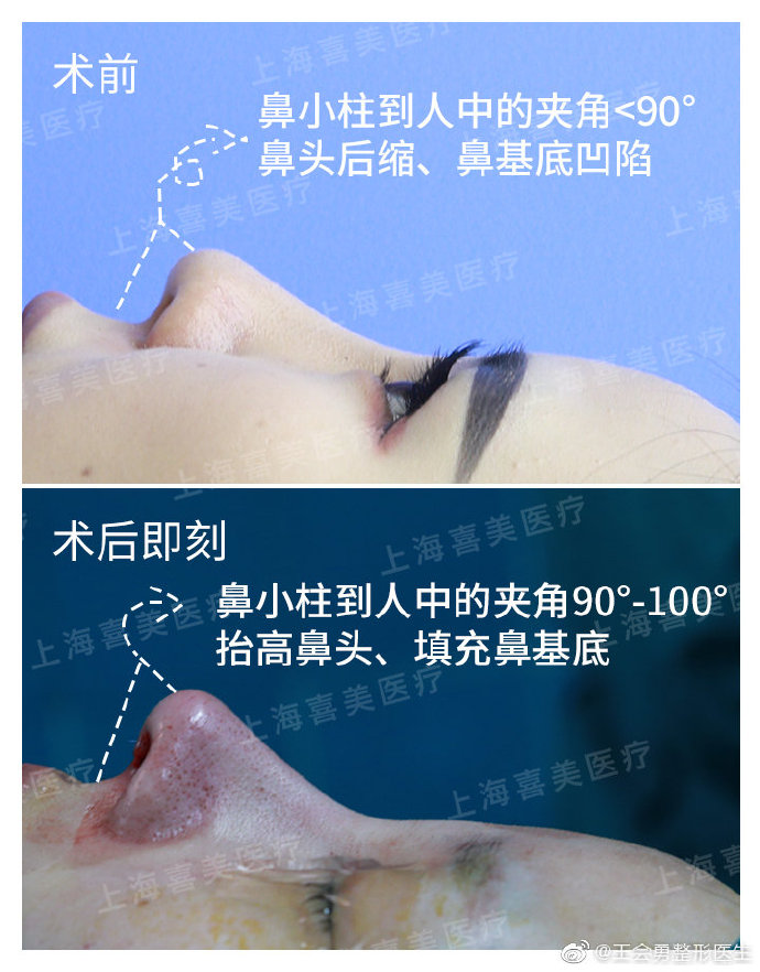 王會勇半肋鼻修復案例