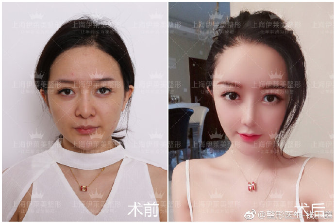 錢玉鑫肋骨鼻案例