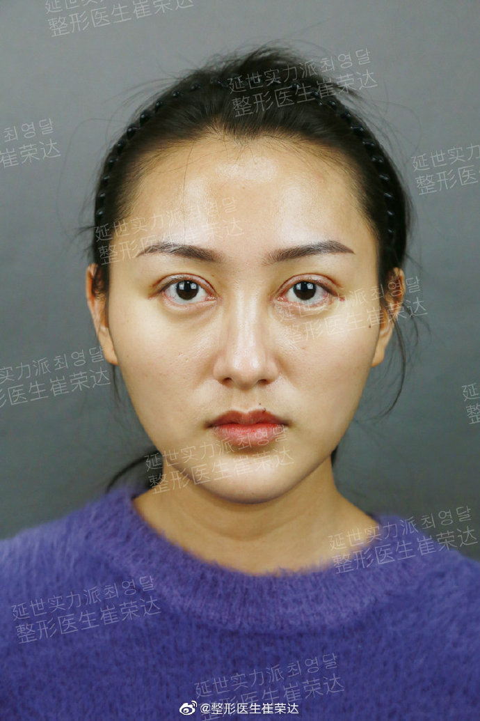 崔榮達面部輪廓案例