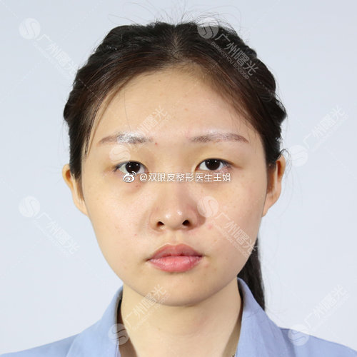 雙眼皮