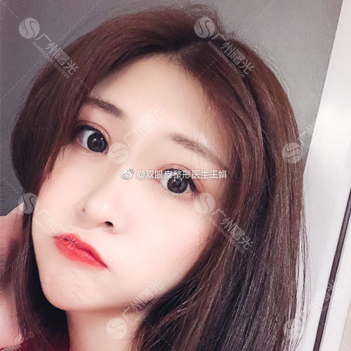 雙眼皮