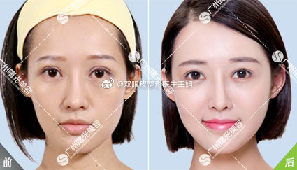 雙眼皮修復(fù)案例