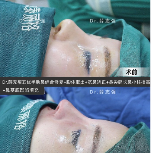 薛志強鼻修復案例