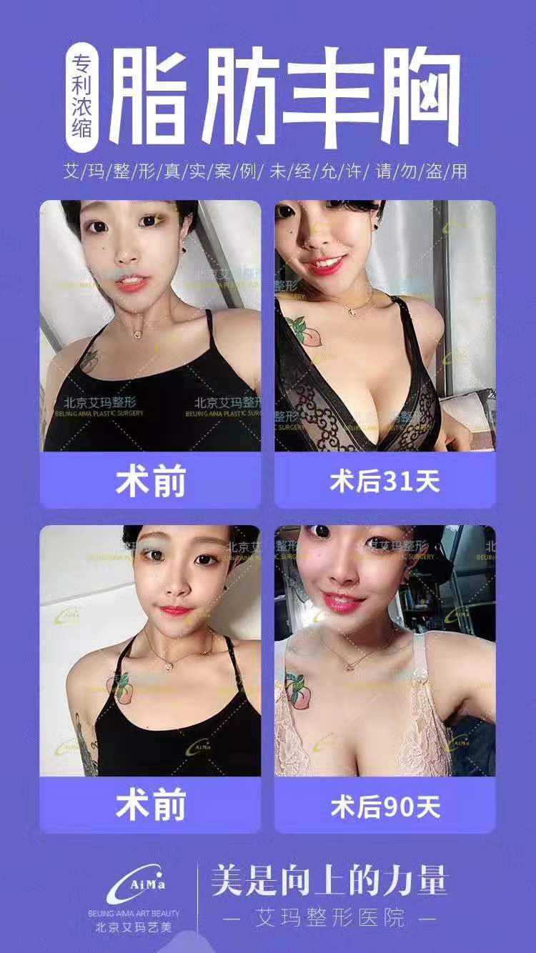 韋元強(qiáng)脂肪豐胸案例
