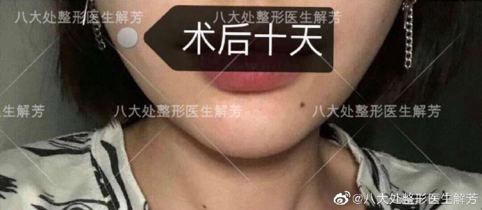 解芳下頜角整形案例