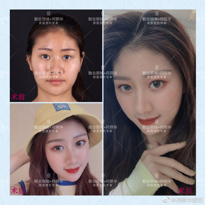 何照華下頜角整形案例