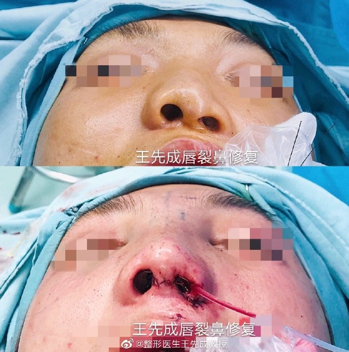 王先成高難度鼻修復(fù)案例