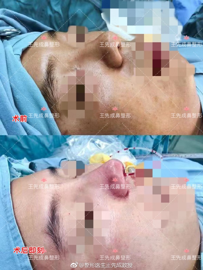 王先成高難度鼻修復(fù)案例