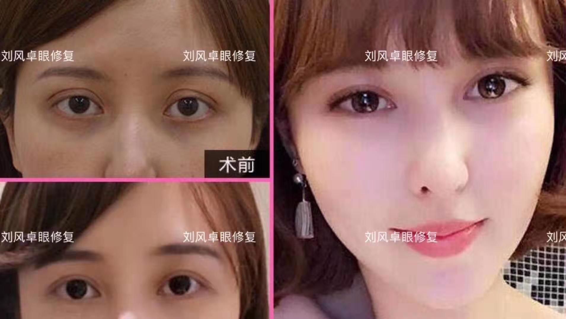 劉風卓雙眼皮修復案例