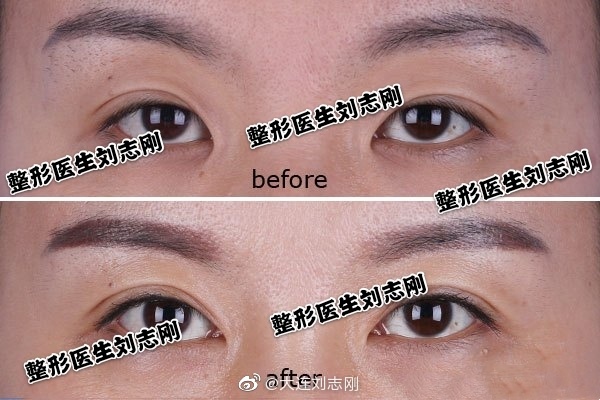 劉志剛雙眼皮修復案例