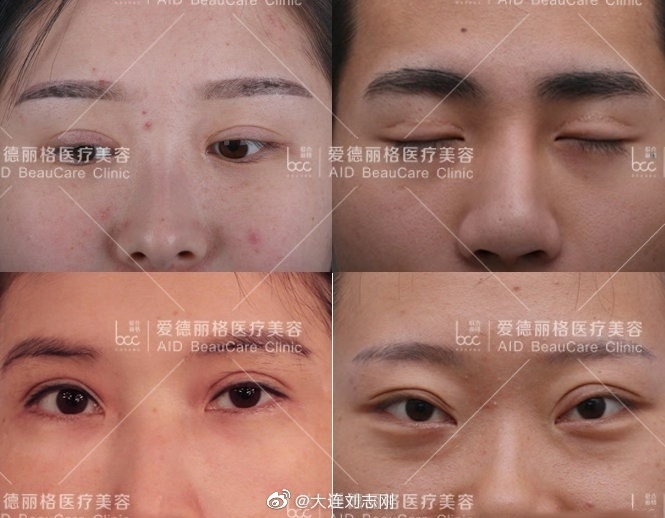 劉志剛雙眼皮修復案例