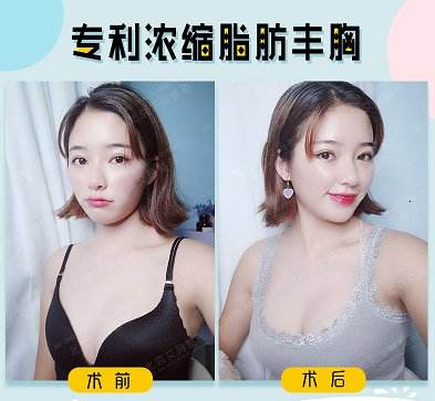 韋元強豐胸案例