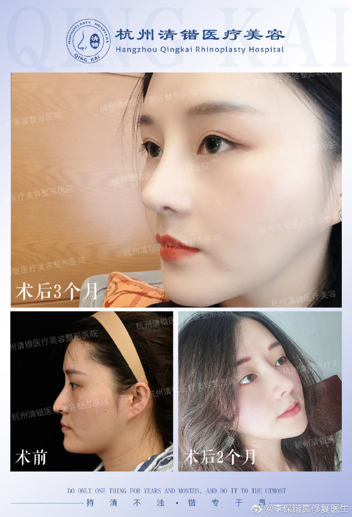 李保鍇鼻修復(fù)案例