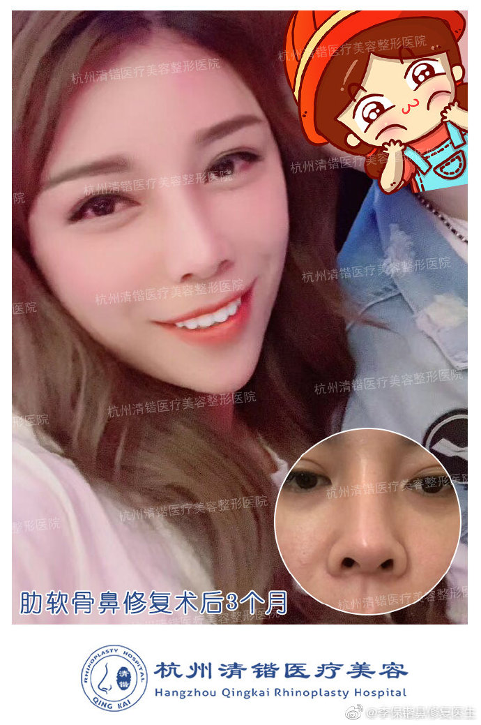 李保鍇鼻修復(fù)案例