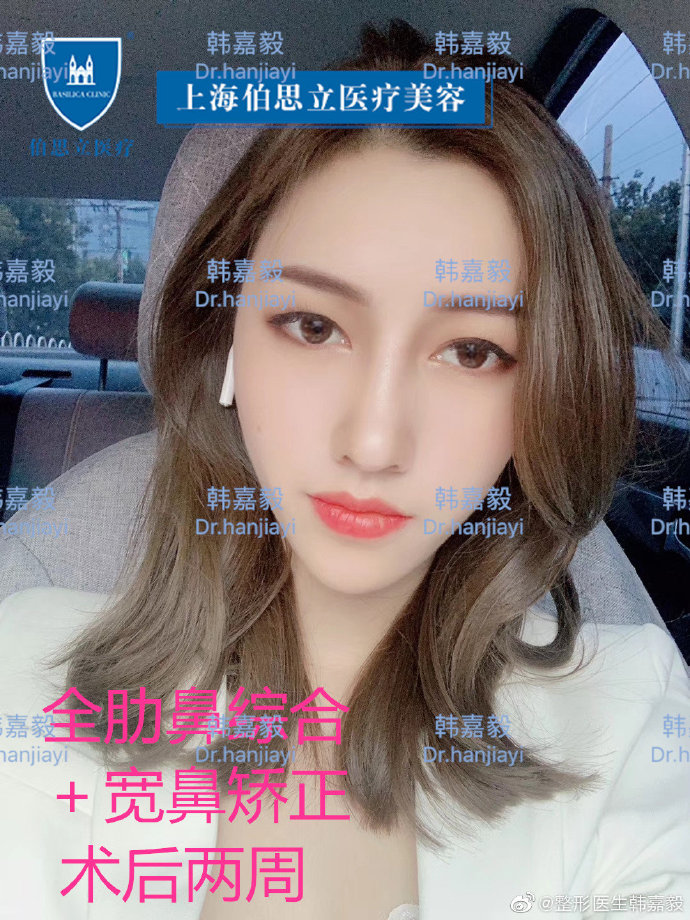 韓嘉毅鼻整形案例