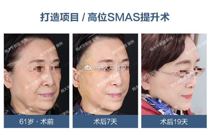 楊大平面部提升案例