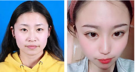 閉眼無(wú)痕雙眼皮