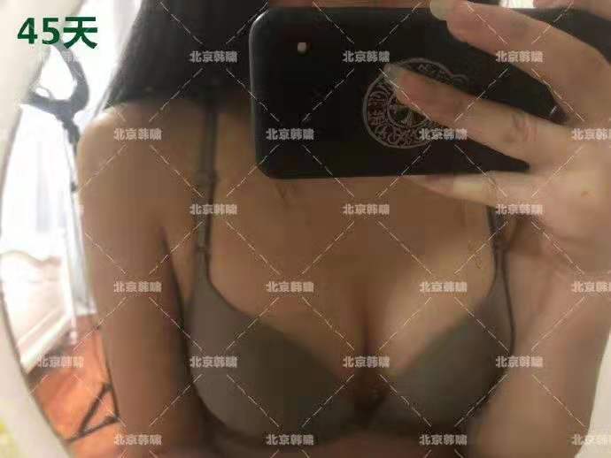 棉花糖豐胸案例
