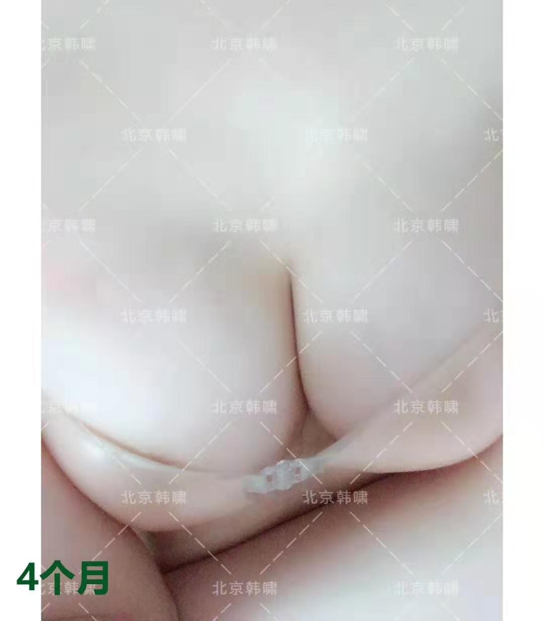 棉花糖豐胸案例