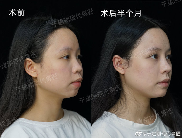 于建剛鼻修復(fù)案例