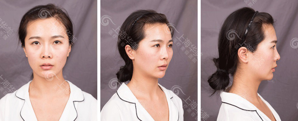 上海華美李健鼻綜合案例