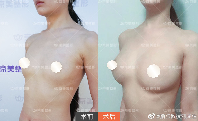 劉成勝脂肪豐胸