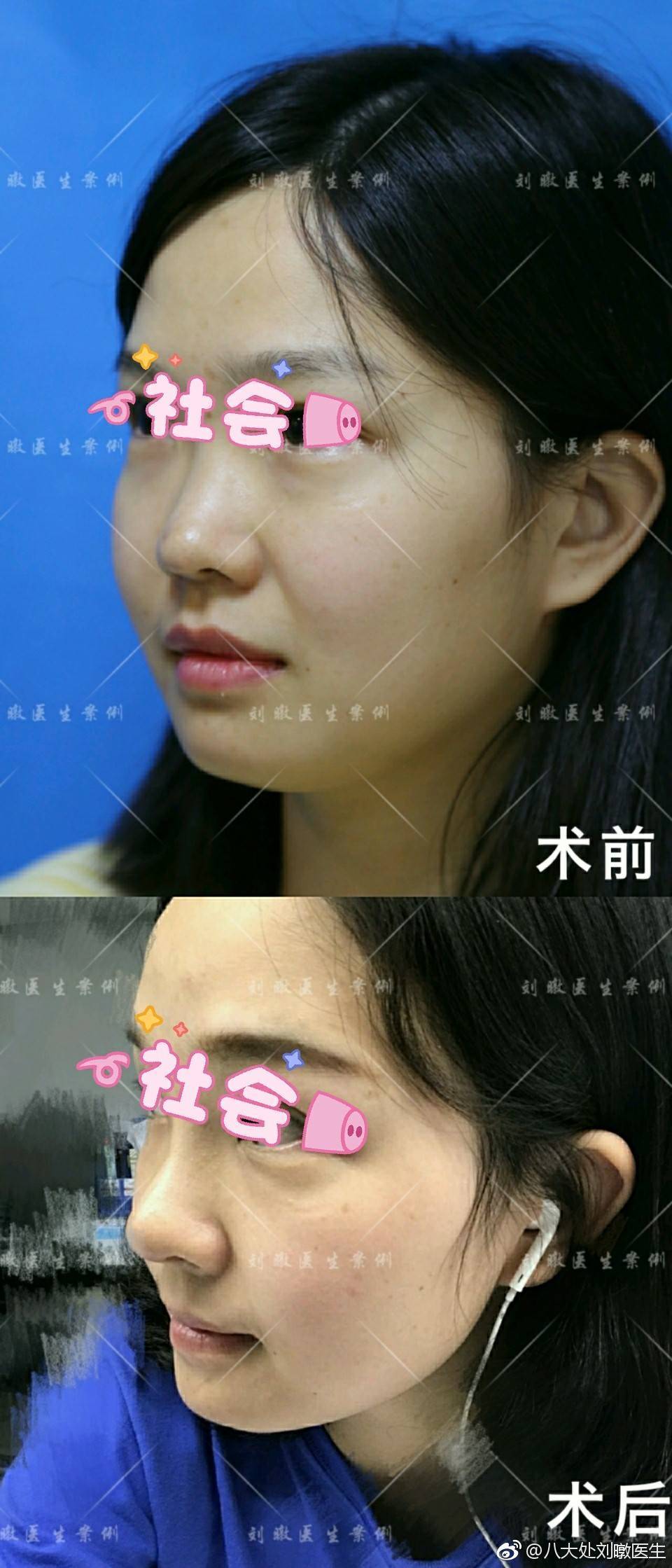劉暾隆鼻案例