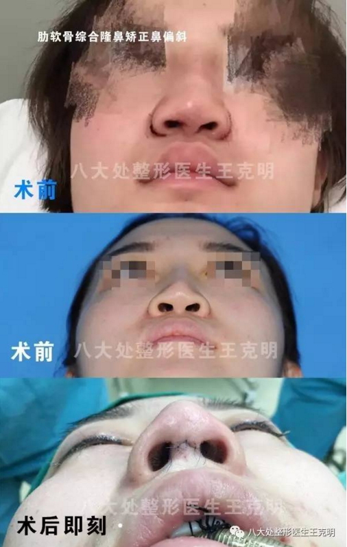 王克明隆鼻矯正案例