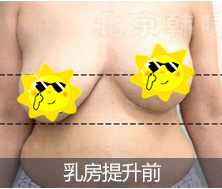 韓嘯乳房下垂提升案例