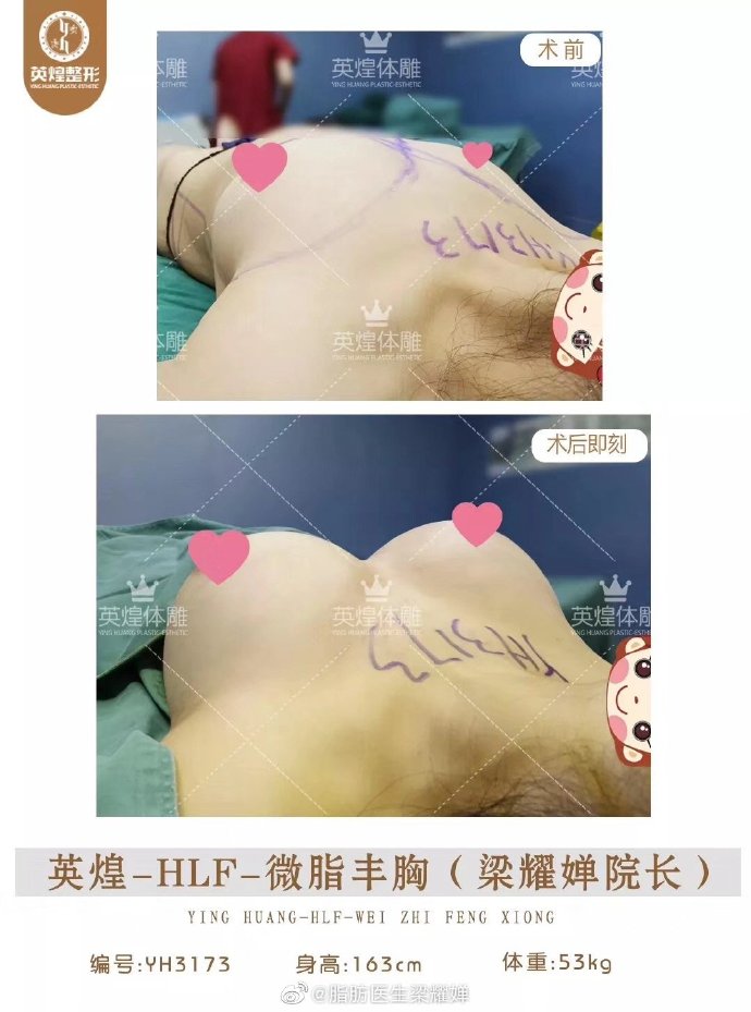 梁耀嬋脂肪豐胸案例