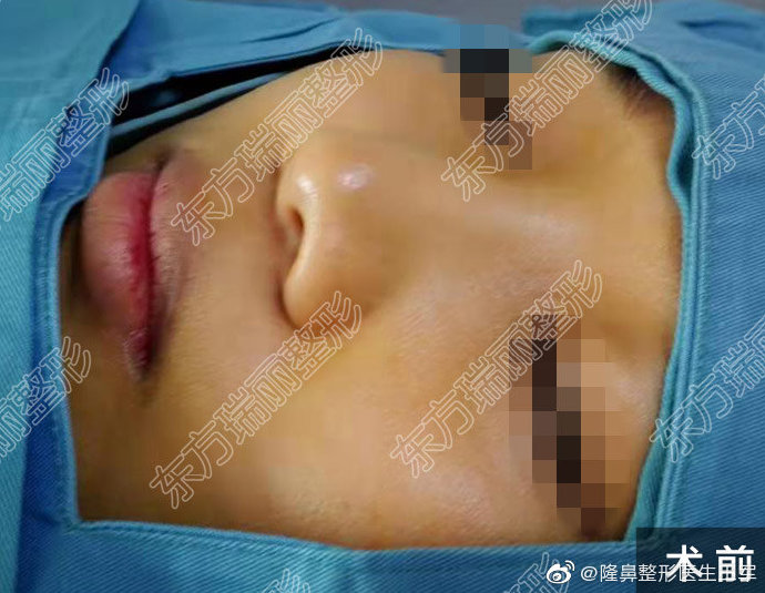 王軍異體骨隆鼻案例