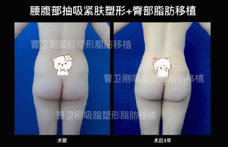 上海豐臀選哪家醫(yī)院較好？李健和邱文苑哪個(gè)更好？