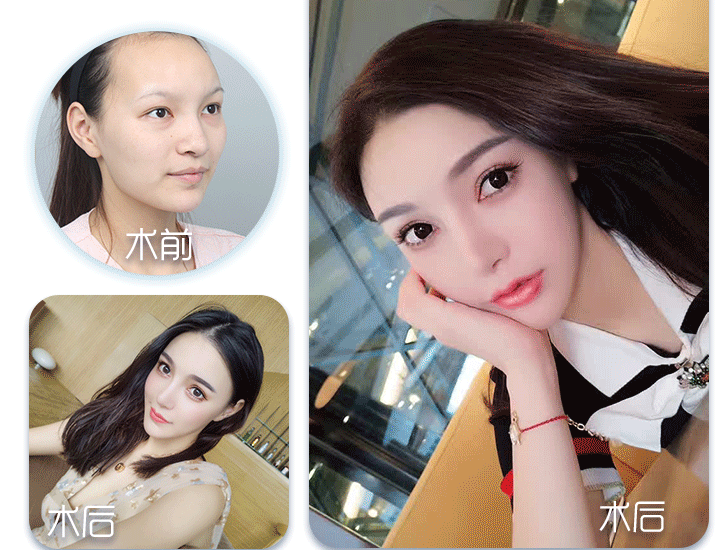 曹棟弼整形案例