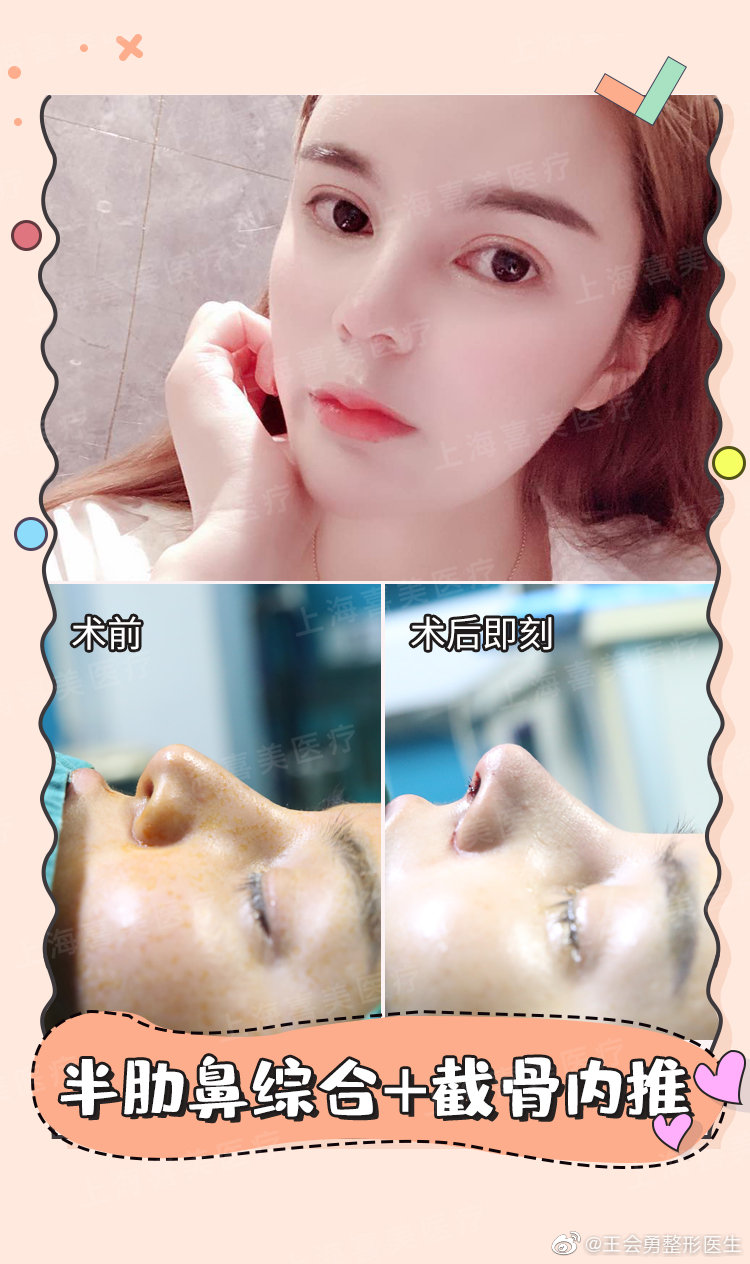 上海最有名氣的鼻王是哪位醫(yī)生？